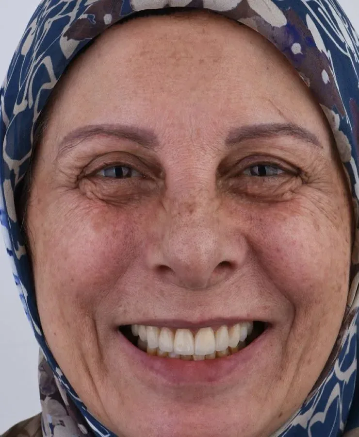 Case 09, after: Porcelain veneers