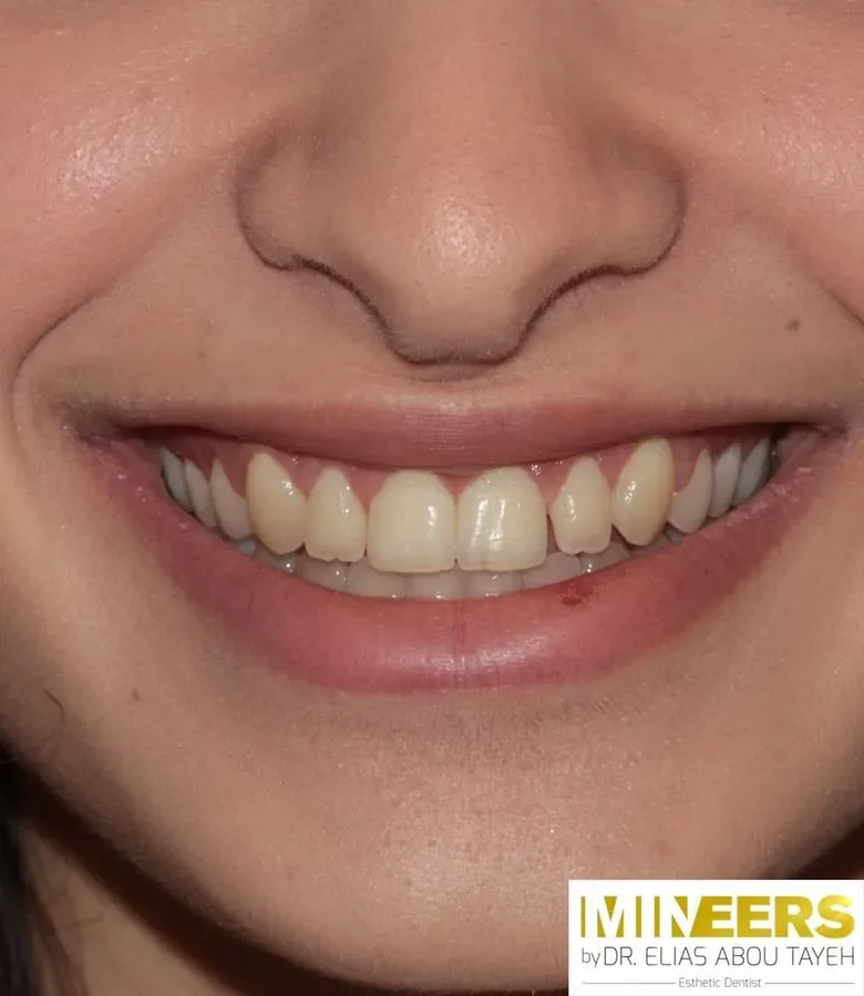 Case 26, after: Gummy smile