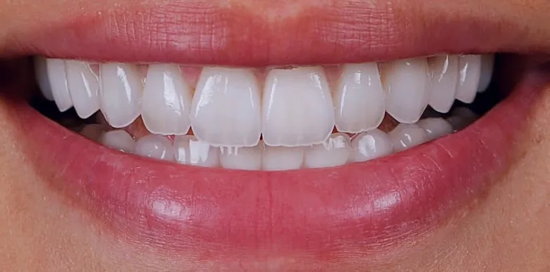 Case 18, after: Porcelain veneers