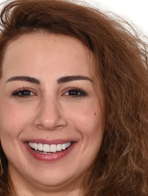 Case 12, after: Porcelain veneers