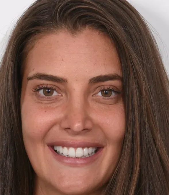Case 15, after: Porcelain veneers