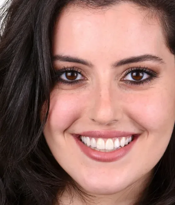Case 28, after: Gummy smile