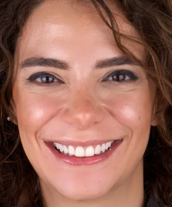 Case 30, after: Gummy smile
