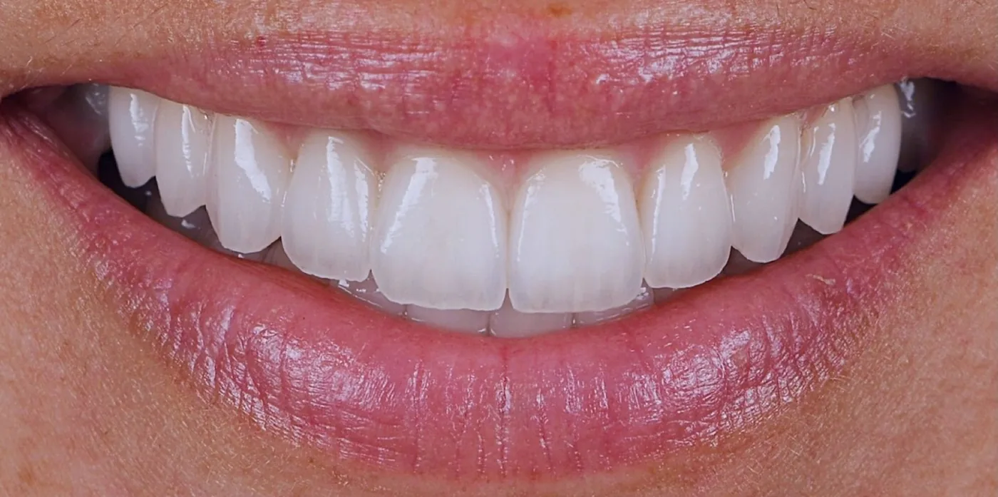 Case 01, after: Porcelain veneers