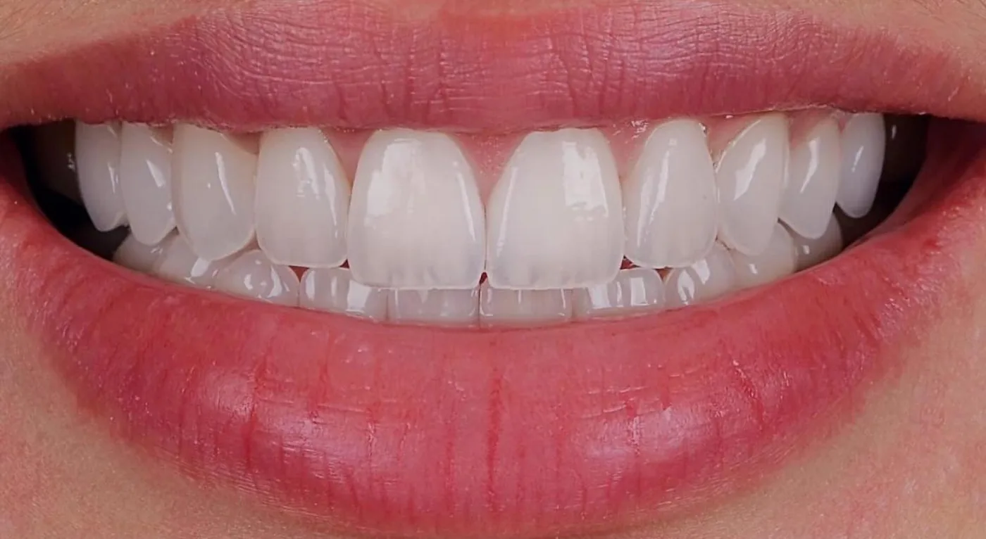 Case 04, after: Porcelain veneers