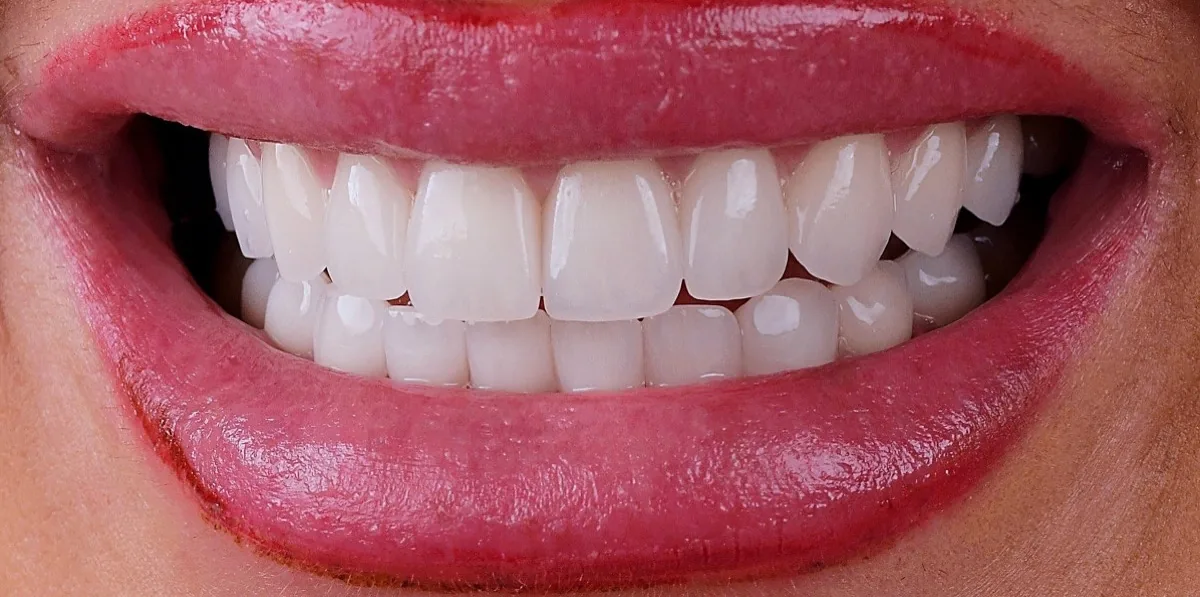 Case 02, after: Porcelain veneers