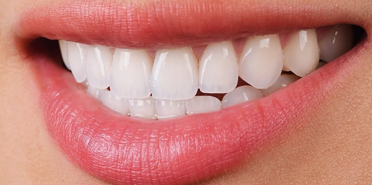Case 03, after: Porcelain veneers