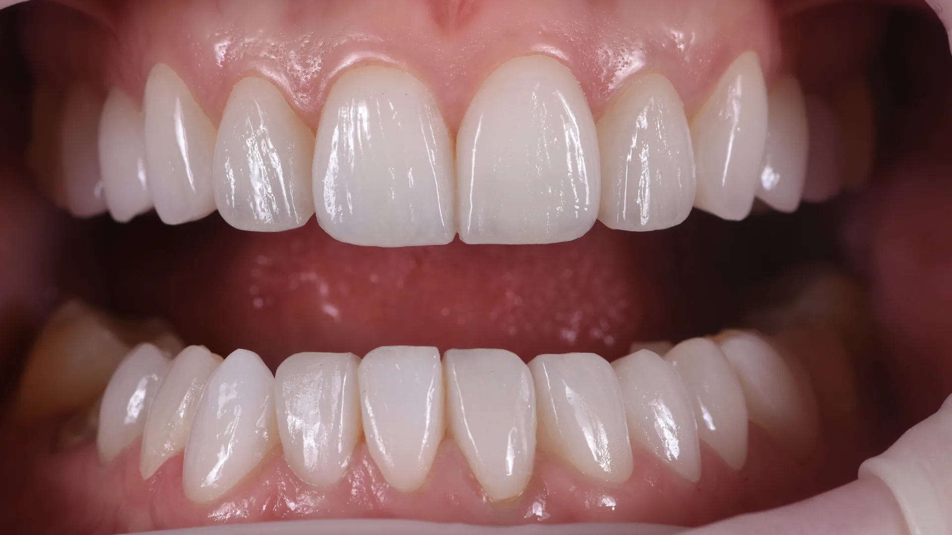 Veneer showcase