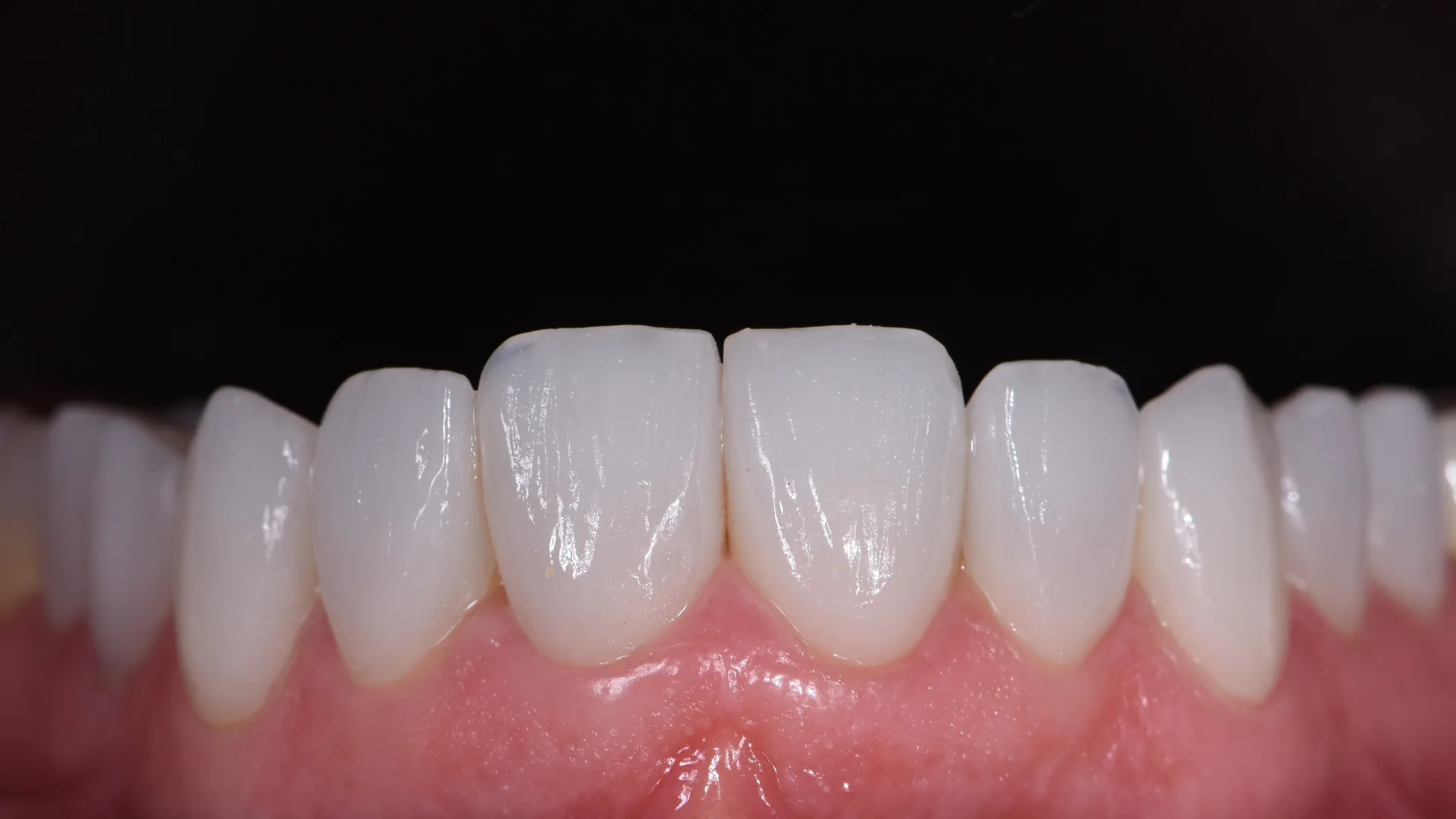 Veneer showcase