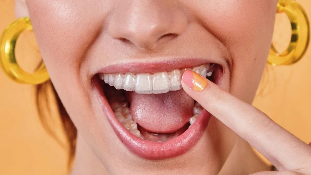 A patient pointing at the clear aligner on her teeth