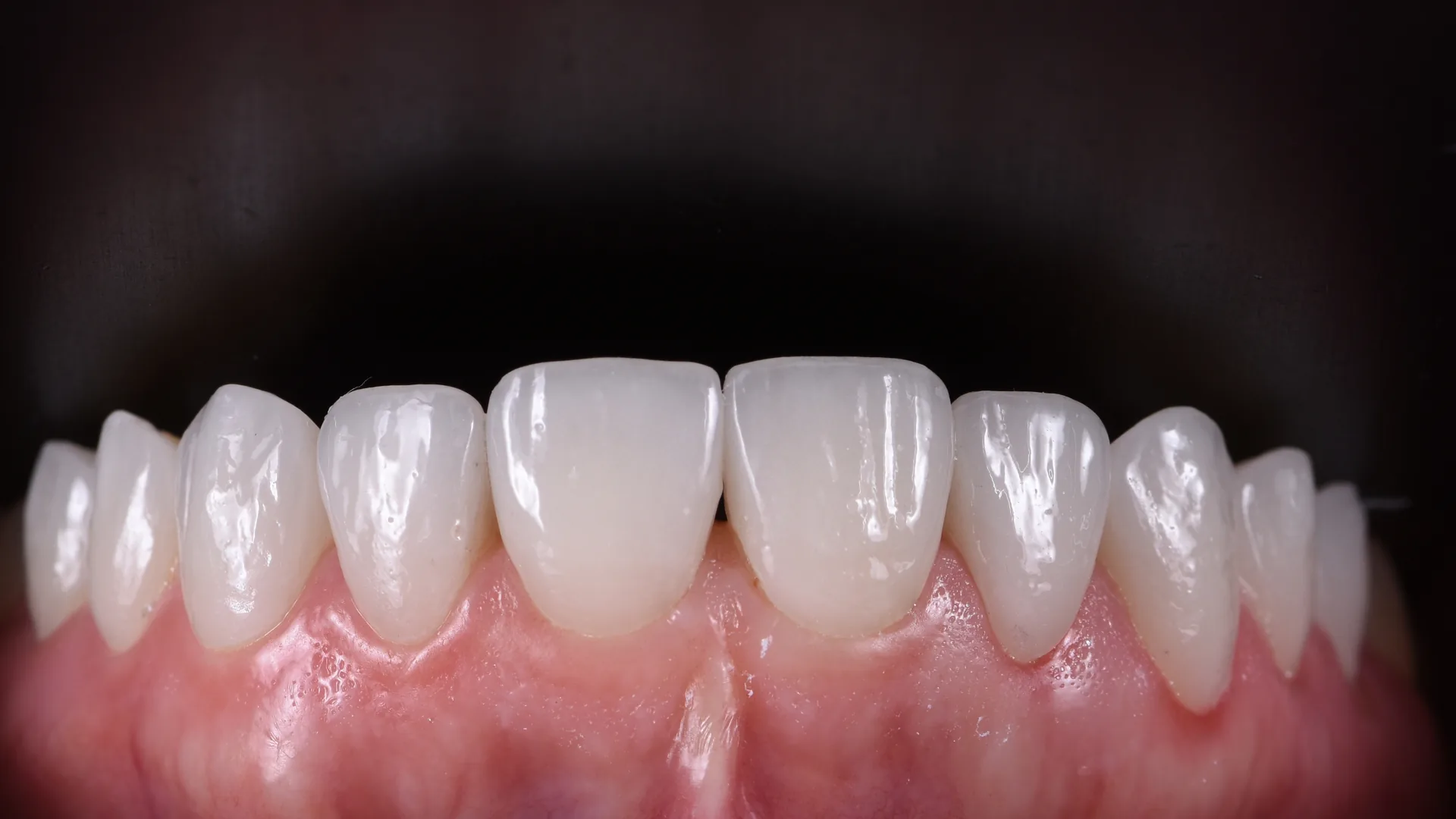 Veneer showcase