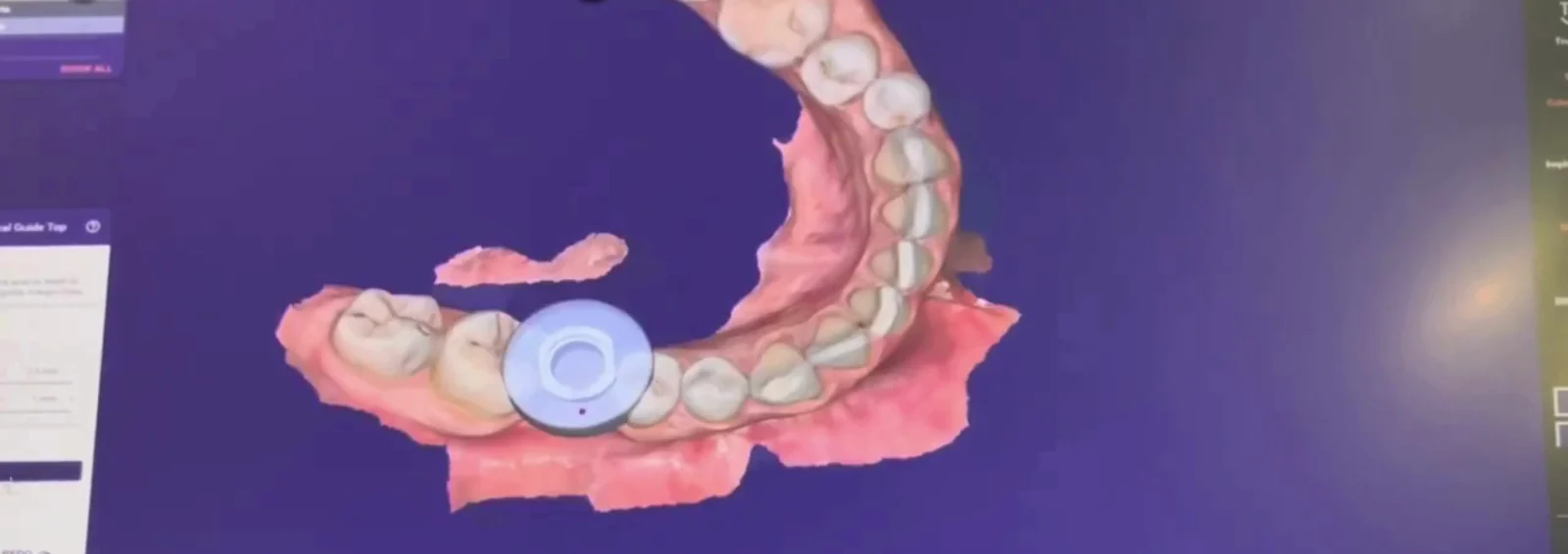 A 3D model of the arch with the planned implant position marked