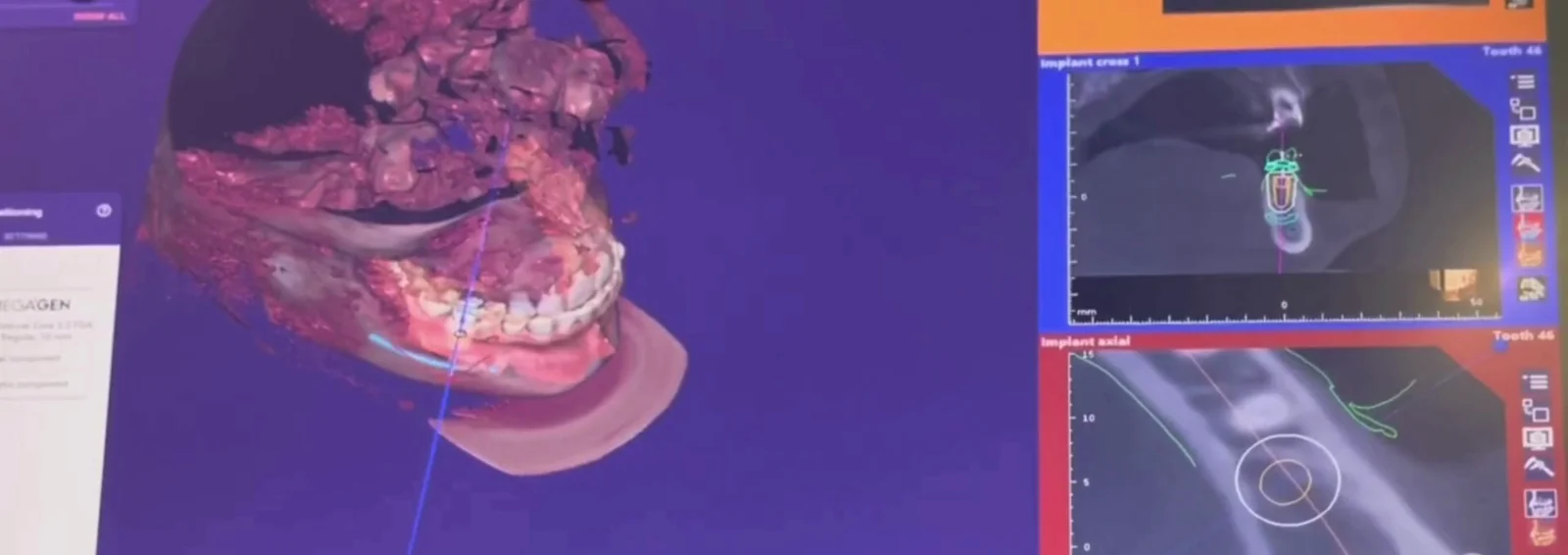 A dental implant planned on a 3D X-ray of the jaw