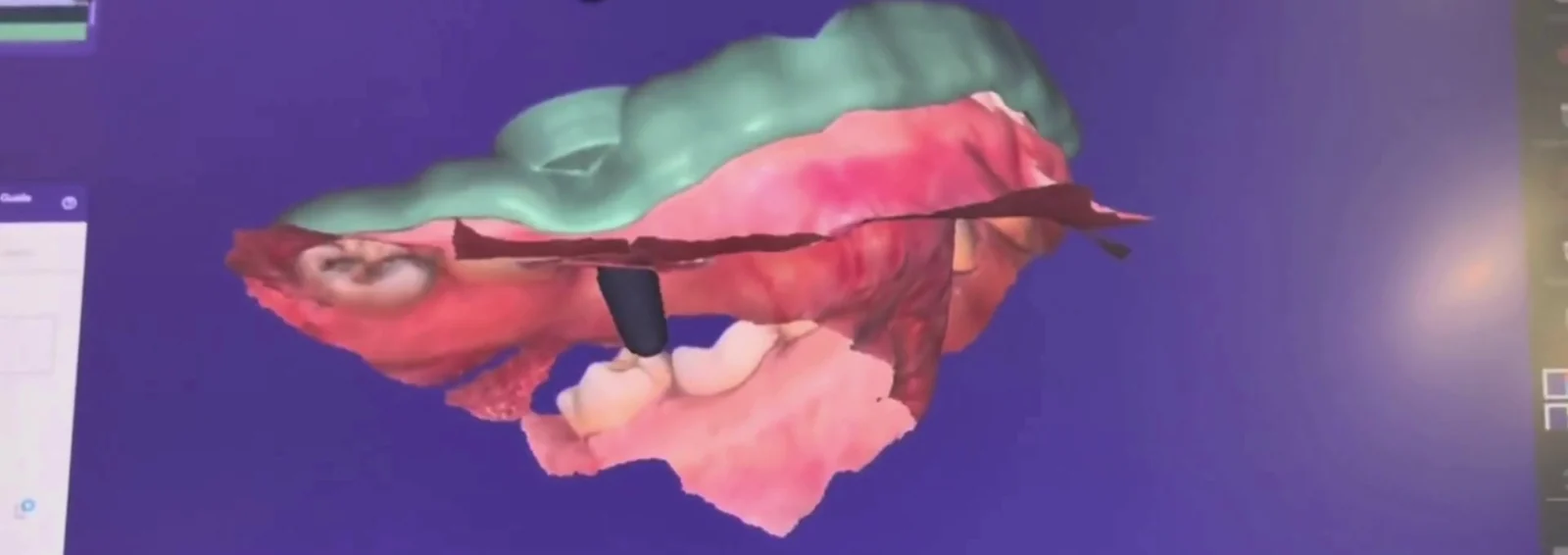 A surgical guide designed on screen over the digital model
