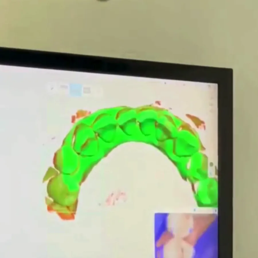 A 3D intraoral scan of the teeth building up on screen