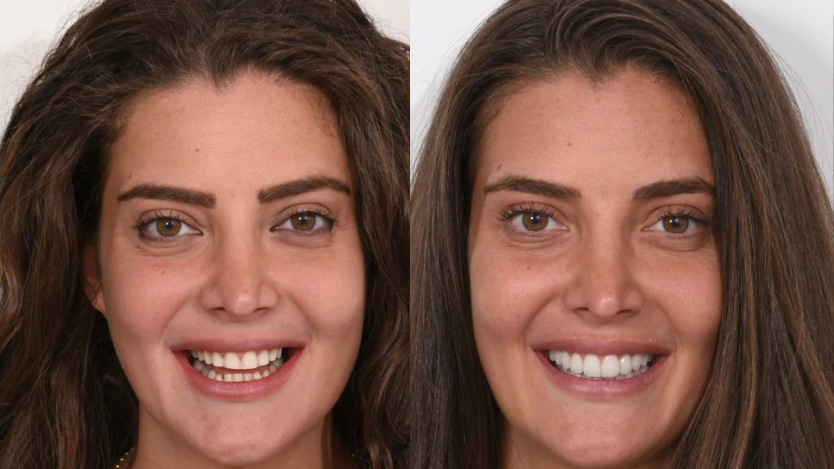 Veneer showcase