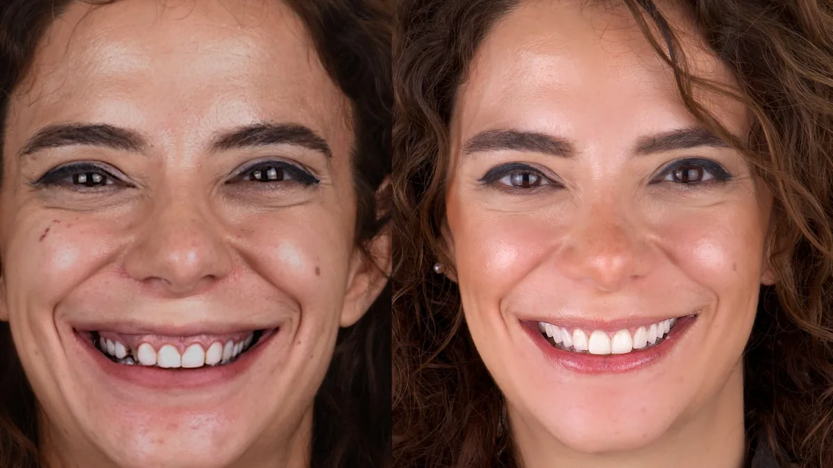 Veneer showcase