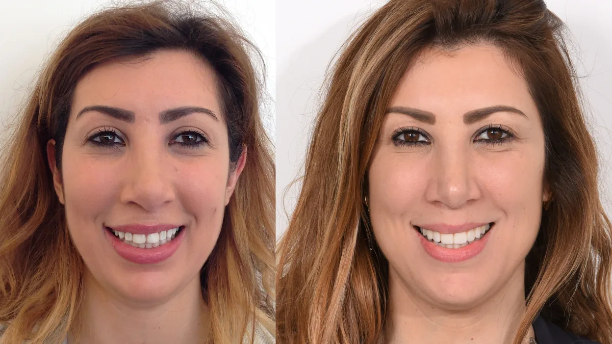 Veneer showcase