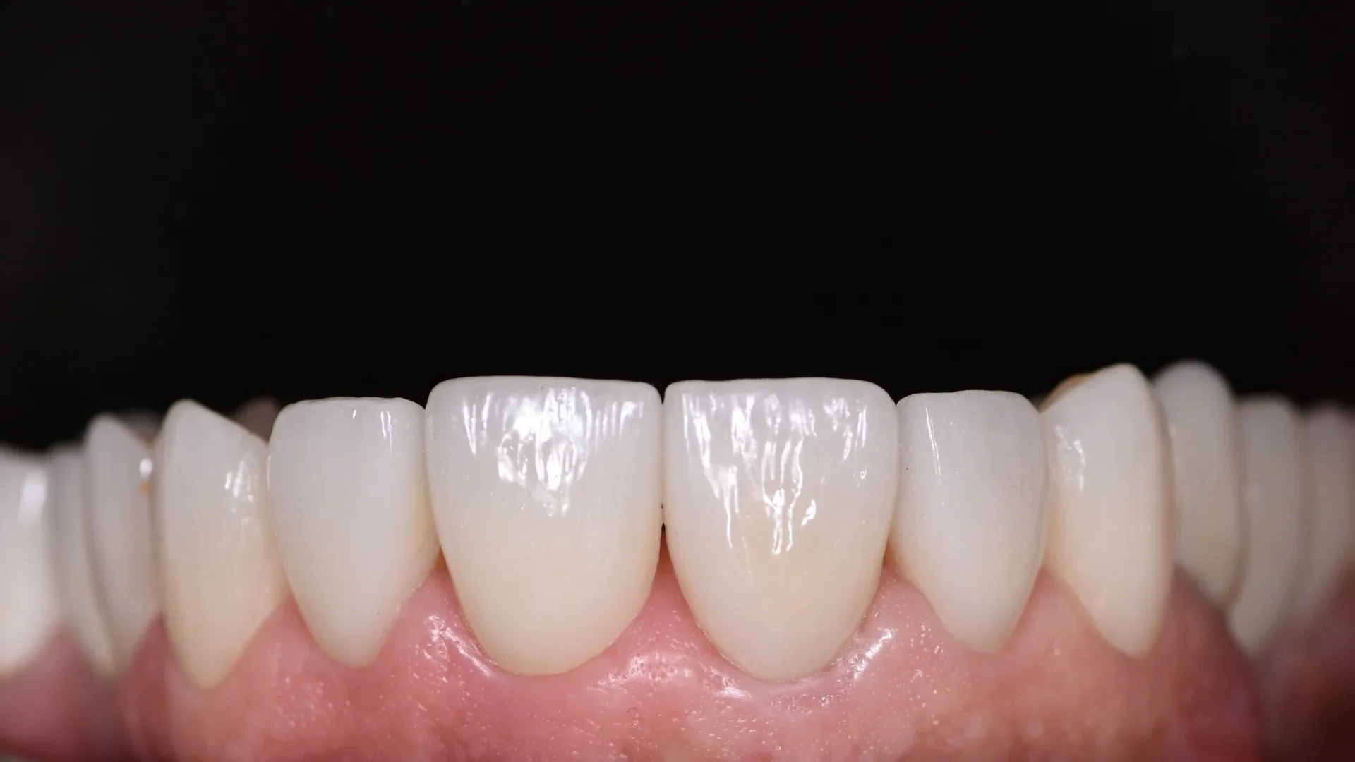 Porcelain veneers on the front teeth, close up, showing their surface texture and the gum line